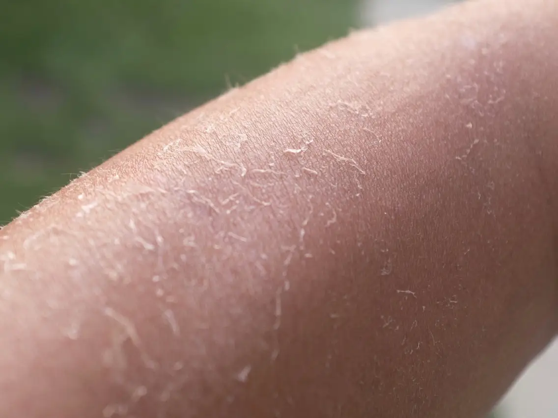 Dry Skin
