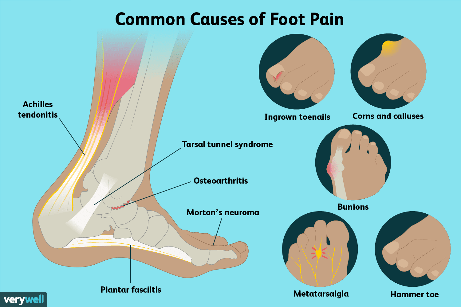 Foot Pain